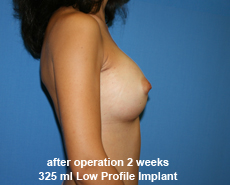 plastic-surgery-breast-augmentation